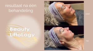 Purles Liftology natuurlijke facelift